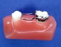 Orthodontics - Band & Loop