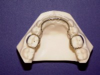 Orthodontics - Lower Lingual Arch