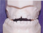 Orthodontics - Openbite