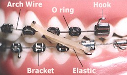 Orthodontics - Braces