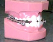 Orthodontics - Herbst