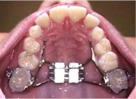 Orthodontics - Palatal Widening Appliance