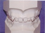 Orthodontics - Overbite