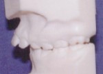 Orthodontics - Overjet
